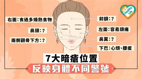 暗瘡位置|13個暗瘡位置反映什麽健康狀態？中醫療法 